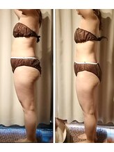 サクラス(SUQRAS)/ビフォーアフター/3回