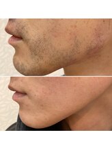 エピシアドットエヌ(epicia.N)/ヒゲ脱毛でスッキリ