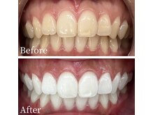 ホワイト 福岡天神店(WHITE)/ホワイトニングビフォーアフター