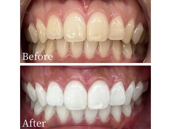 ホワイト 福岡天神店(WHITE)/ホワイトニングビフォーアフター