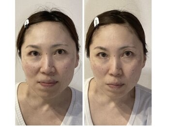 小顔22 ボルティ 本店(Bolty)/40代:施術1回