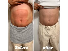 ウナ 福岡店(UNA)/モニター様★お腹 4cup