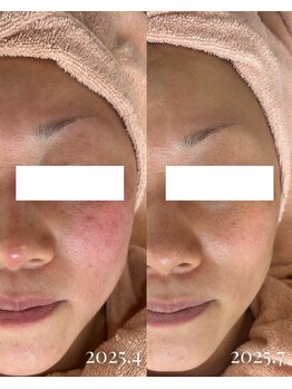 ミュー 多治見店(mieux)/◆肌質改善例