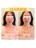 【移転1周年】SEN美容鍼×肩甲骨剥がし猫背改善or肌管理炭酸ガスパック