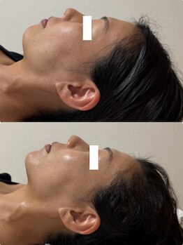 ユニ(Uni)/30代 高周波・リジェセル