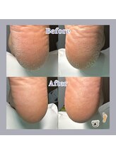 巻き爪補正店 天王寺店/かかとのガサガサもスッキリ！