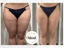 アイディール(ideal)/脂肪減少10ミリコース