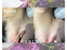 オーエスガーデン 帯広(OS Garden)/【ビフォーアフター】うなじ脱毛