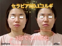 セラピアの雰囲気（小顔コースによるエラはり、フェイスラインの変化に感動！）