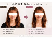 小顔ラボ 心斎橋店(小顔LABO)の雰囲気（【小顔効果】お悩みに合わせた施術で根本改善★）