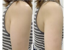 アトリエ ハルミナ(atelier harumina)/人気痩身マシン//ほっそり二の腕