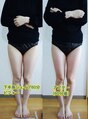 シンシア(SINCERE) 下半身シェイプ施術６０分後のビフォーアフターです。