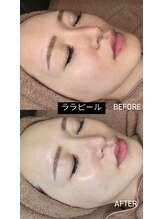 美容整骨小顔ラボ/ララピールビフォーアフター