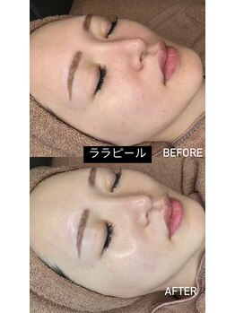 美容整骨小顔ラボ/ララピールビフォーアフター
