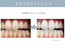 【セルフホワイトニング】医療機関監修の本格美白！