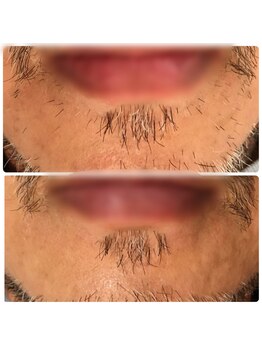 ダブルオー 銀座(00)/美容電気脱毛/髭デザイン脱毛