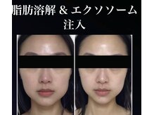 ラグゼ(Ra-Xe)の雰囲気（脂肪分解＆エクソソーム注入で即小顔・エラハリ解消を実感！）
