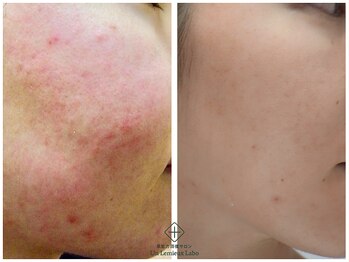 アンレミューラボ(Un Lemieux Labo)/ニキビ、赤み、毛穴改善