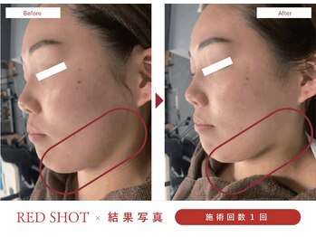 ハレア(HALEA)/レッドショット下顔面 2cc B/A