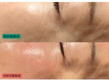 やなけん 亀戸店/目尻のシワ　施術回数 4回