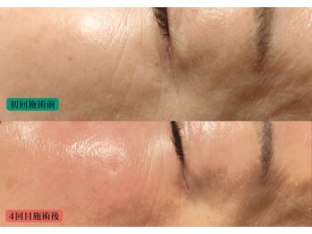 やなけん 亀戸店/目尻のシワ 施術回数 4回