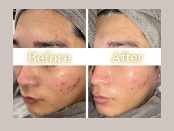 ハル(HARU.)/ハーブピーリング