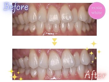 エクシアホワイトニング 天王寺店/ホワイトニングビフォーアフター