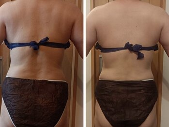 シャルマン(charmant)の写真/福岡希少の痩身で年齢とともに気になる太もも・お尻のたるみ改善!脂肪燃焼グロッティプロ痩身コース¥15000