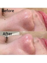 ブライダルエステ ジュエル(JEWEL)/毛穴エクストラクション