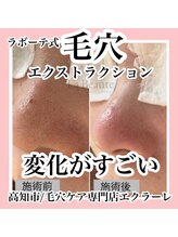 エクラーレ(Eclale)/【毛穴ケア】症例