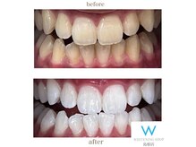 【回数券でお得にホワイトニング】飲食の制限はありません♪