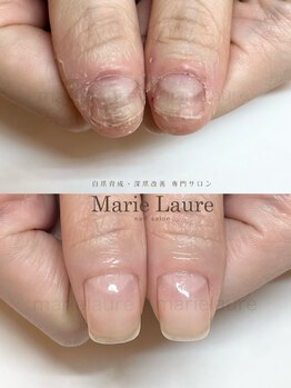 マリーロール 淀屋橋本店(Marie Laure)/自爪育成/深爪矯正/ネイルケア