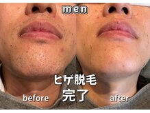 キュー(cue)/【メンズ】「ヒゲ脱毛」完了♪