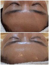 エム(M)/水光3Dピーリング