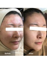 モカ 天王寺店(MOKA)/ホホニキビケアハーブピーリング