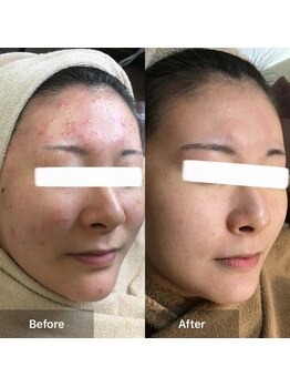 モカ 天王寺店(MOKA)/ホホニキビケアハーブピーリング