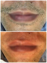 ダブルオー 銀座(00)/美容電気脱毛/ヒゲ脱毛