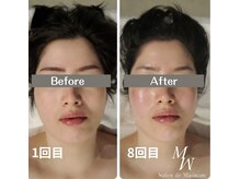 ミピマムマール(Mipimam Maaru)/お客様before→after