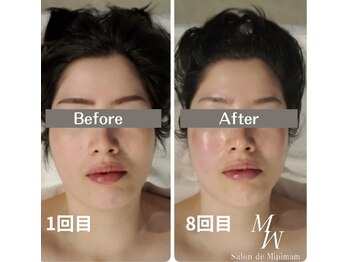 ミピマムマール(Mipimam Maaru)/お客様before→after