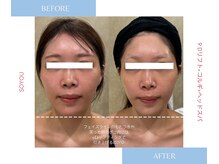 ソユ(SOYOU)/施術* 　９Dリフト