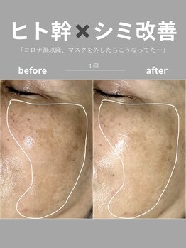 シイ(total skin beaute sii)/50代　ヒト幹細胞導入　1回