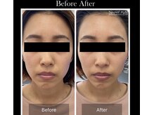 シアン(CYAN)/フェイシャル施術1回