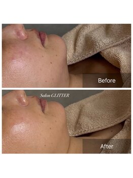 サロン グリッター 新宿(Salon GLITTER)/【肌質改善】ビフォーアフター