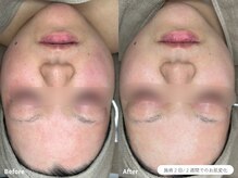 フォンビューティー(fon beauty)/敏感×赤みケア2回