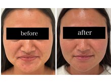 ローゼ(ROSE)/【エイジング】【小顔効果】