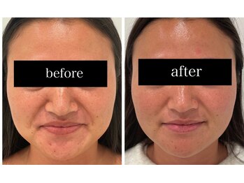 ローゼ(ROSE)/【エイジング】【小顔効果】