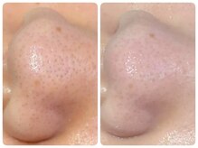 トータルビューティ ノイド(Noid)/いちご鼻　撃退コース