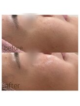 ペルボヌール 深井店/ワックス脱毛×剥けないハーブ