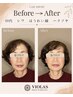 【老け見え改善に】シワ・ほうれい線・たるみ専門美容鍼灸60分