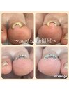 巻き爪ケアもお任せ♪